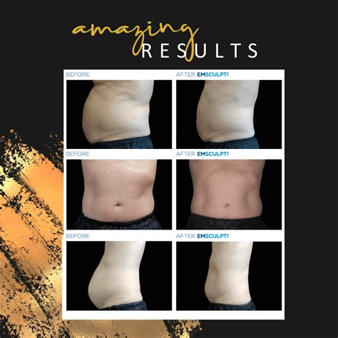 EMSCULPT NEO More Muscle Less Fat .